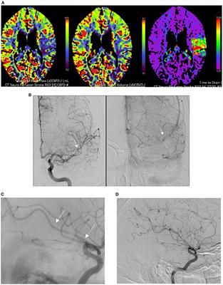 Initial Experience Performing Mechanical Thrombectomy With the CatchView Mini Device for Distal M2 Segment Middle Cerebral Artery Occlusions